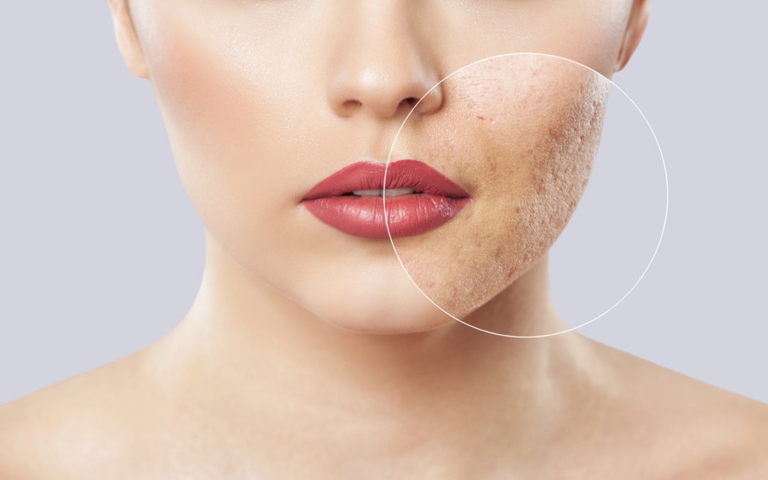 Acne, Marks and Scarring