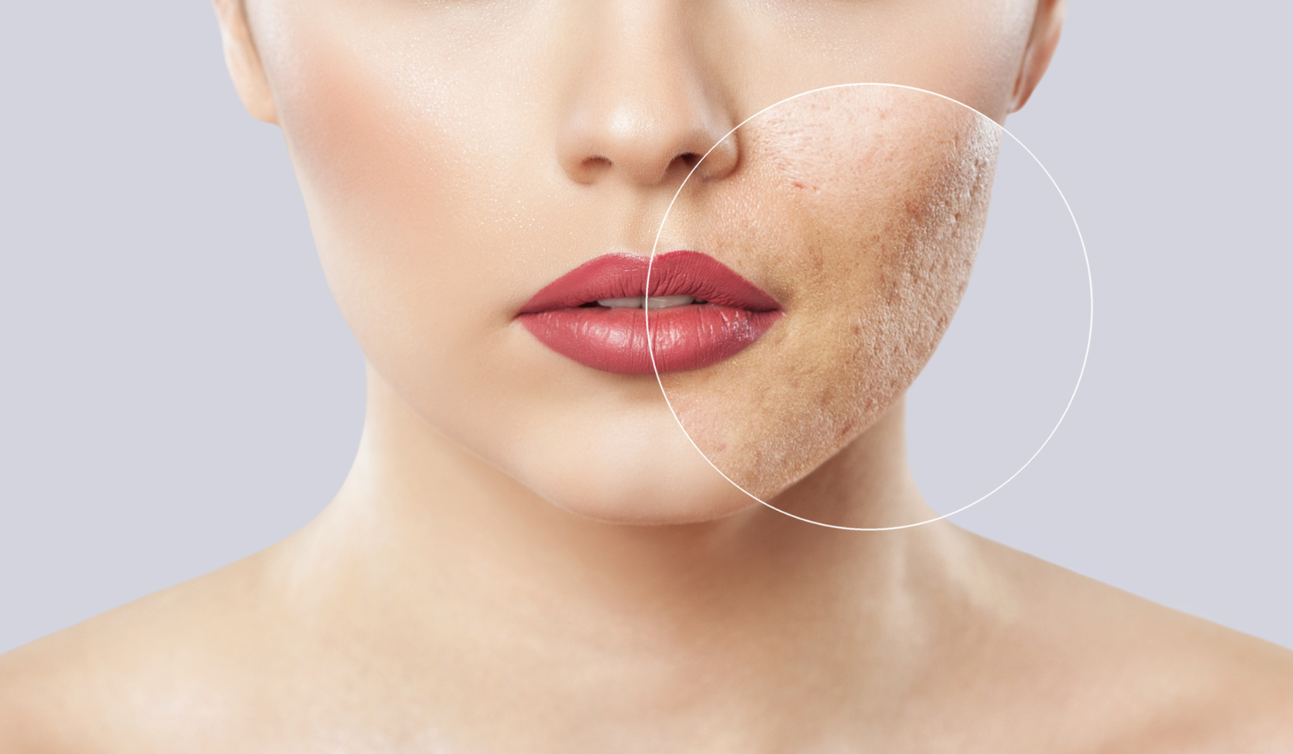 Acne, Marks and Scarring